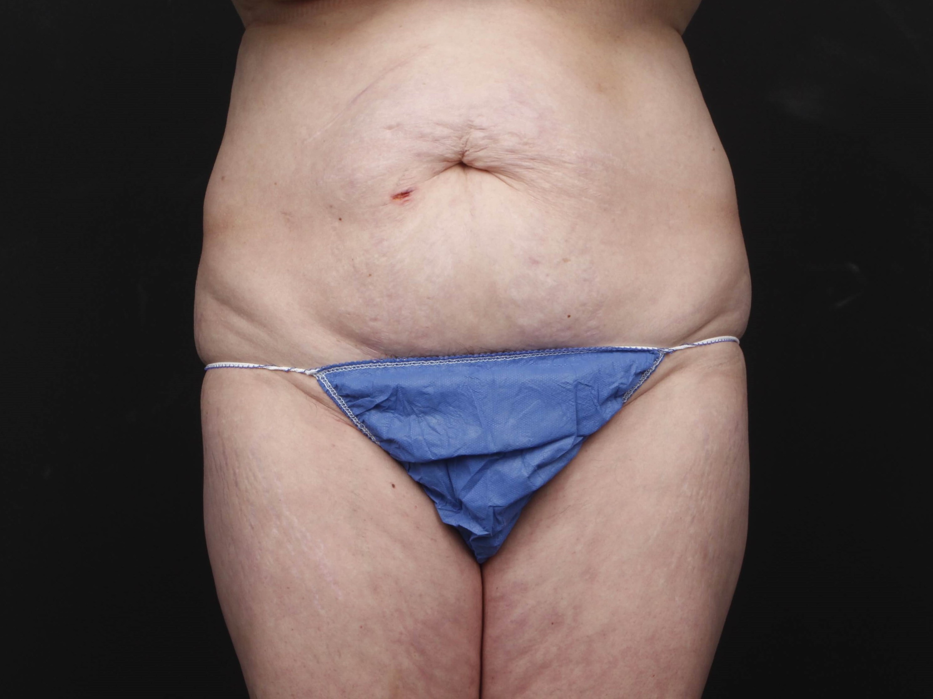 Tummy Tuck with Liposuction Before