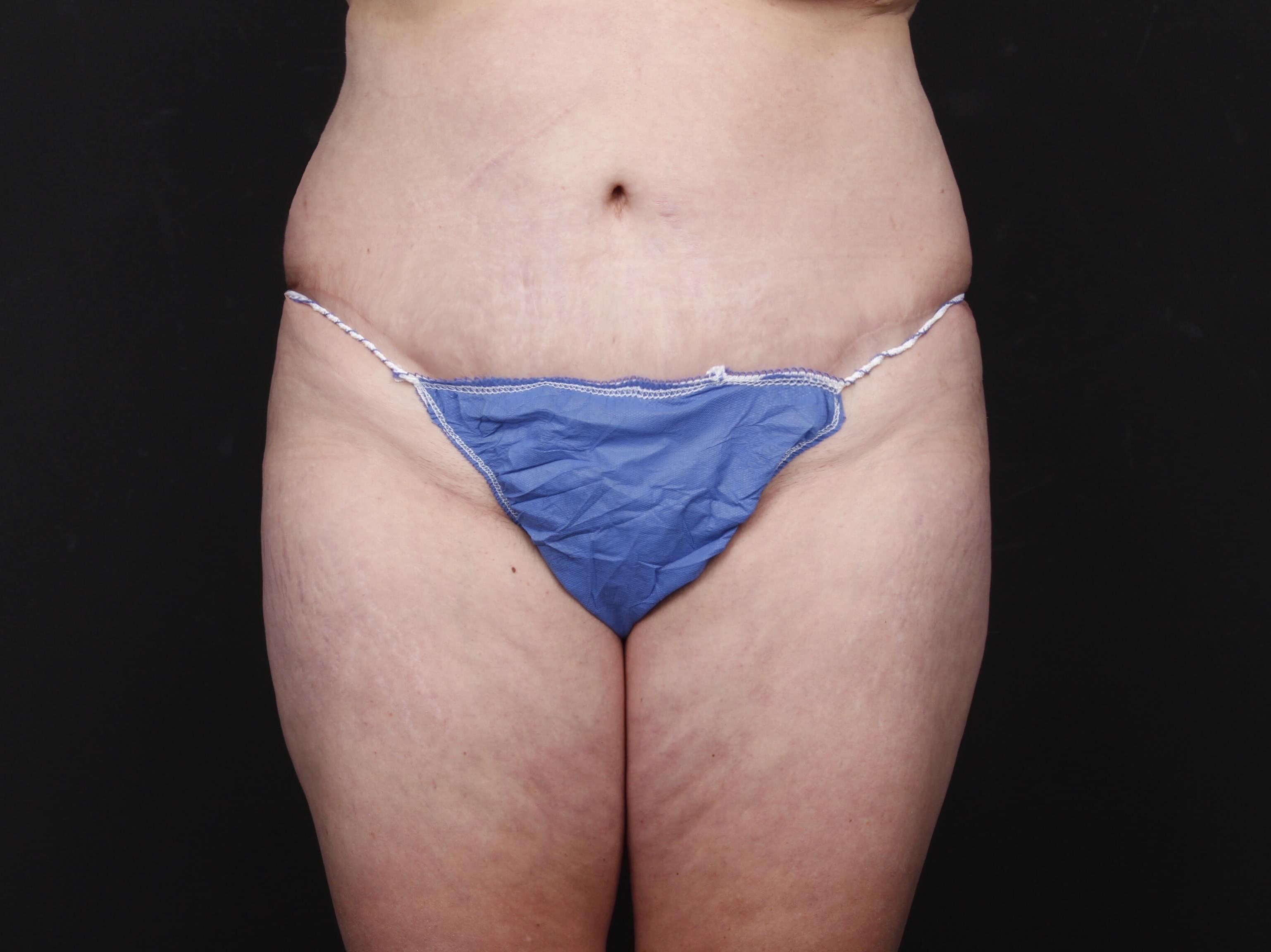 Tummy Tuck with Liposuction After