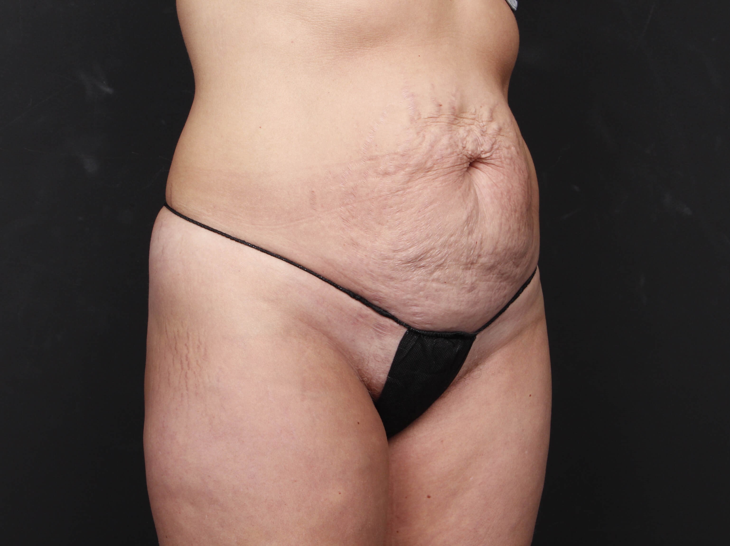 Tummy Tuck with Liposuction Before