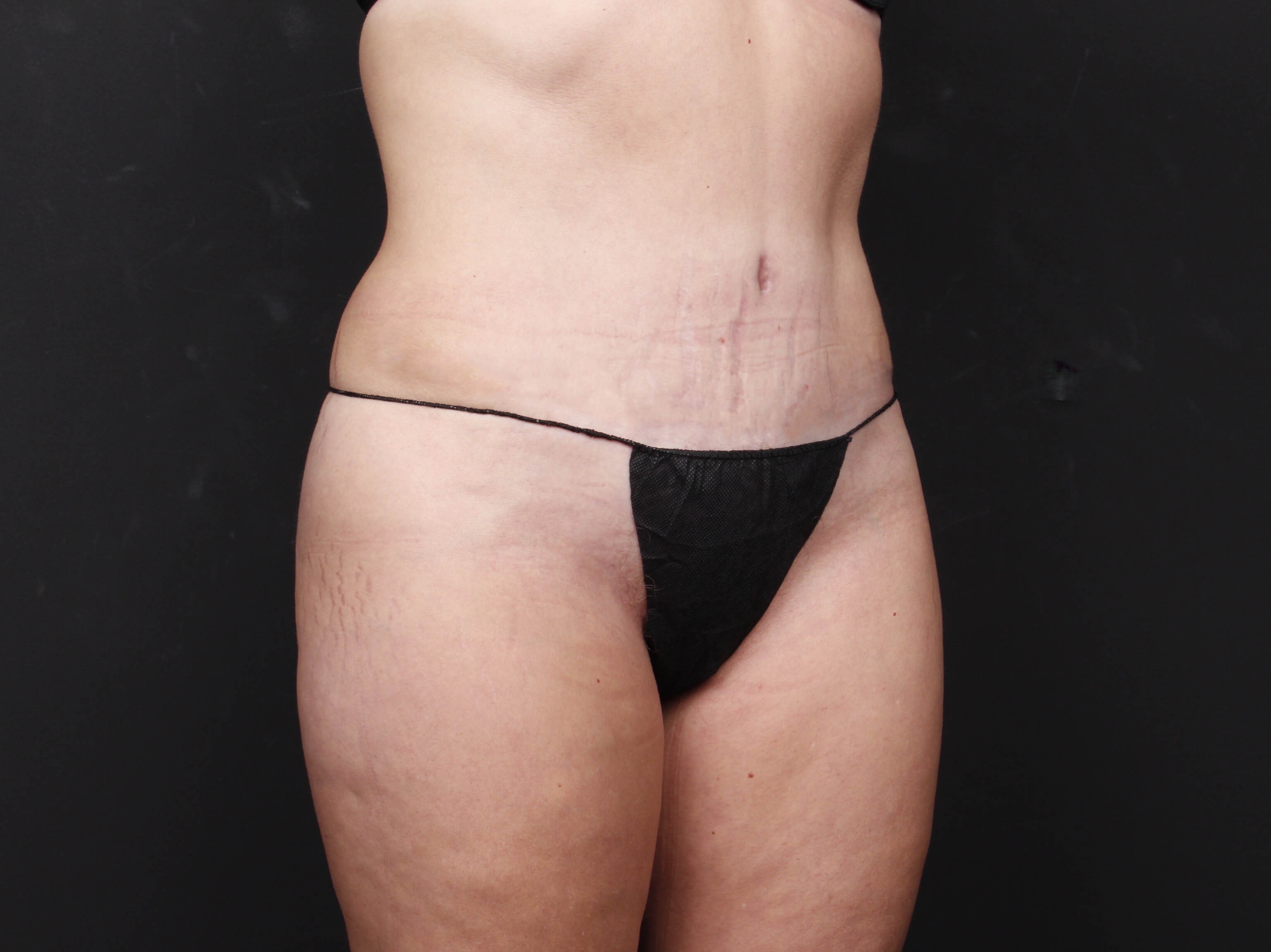 Tummy Tuck with Liposuction After