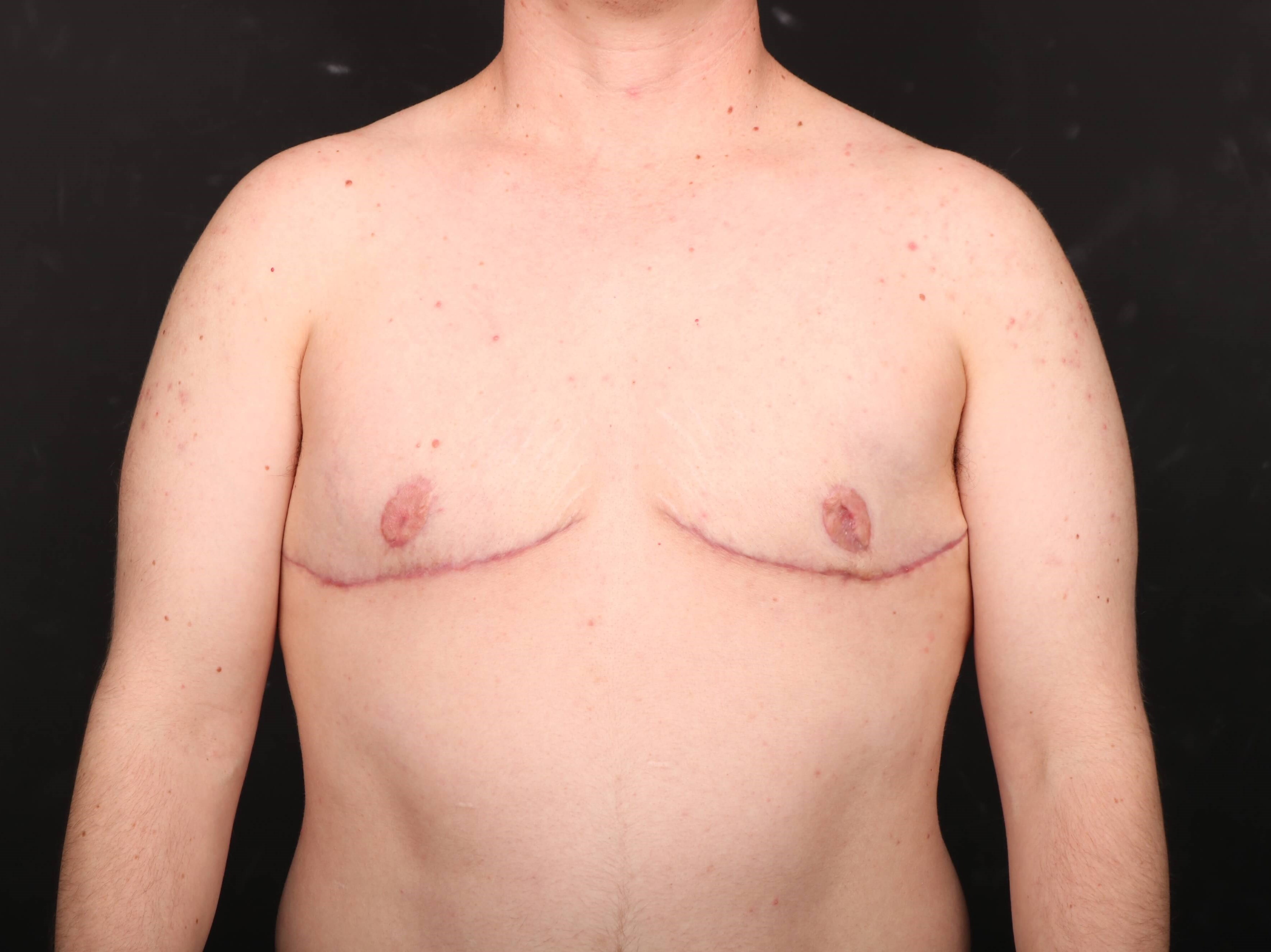 Double Incision Top Surgery After