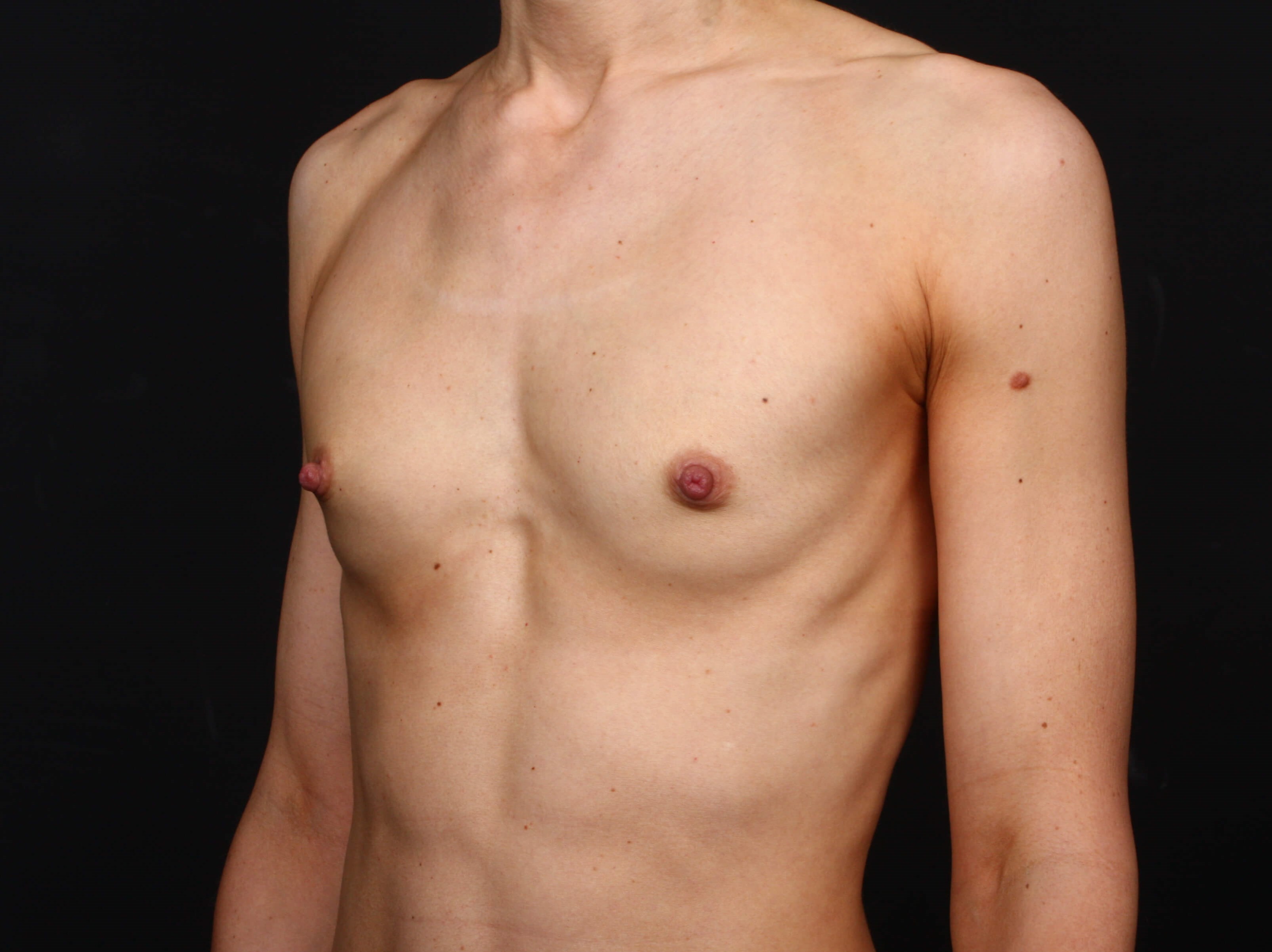 MTF Top Surgery Before