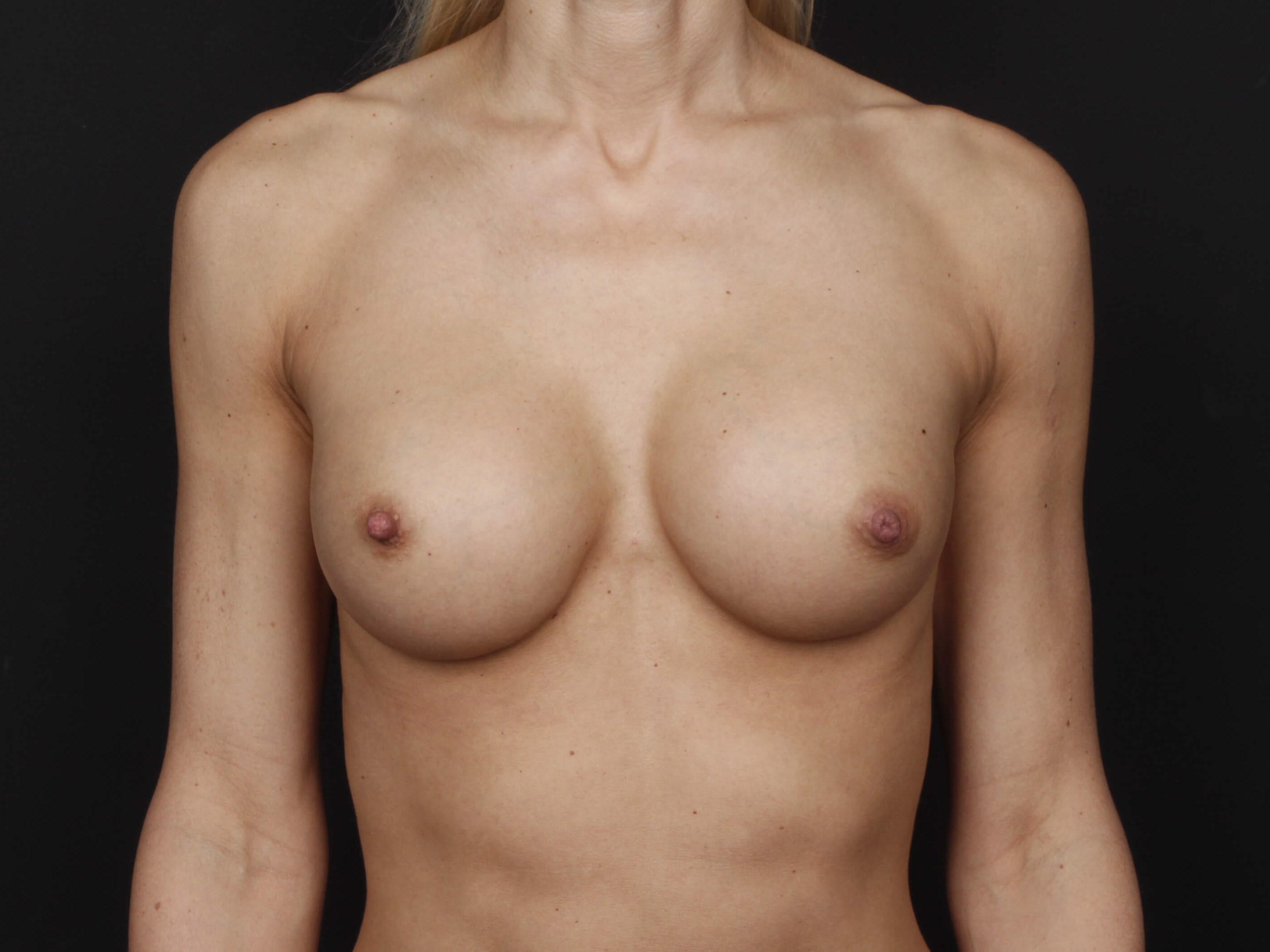 MTF Top Surgery After