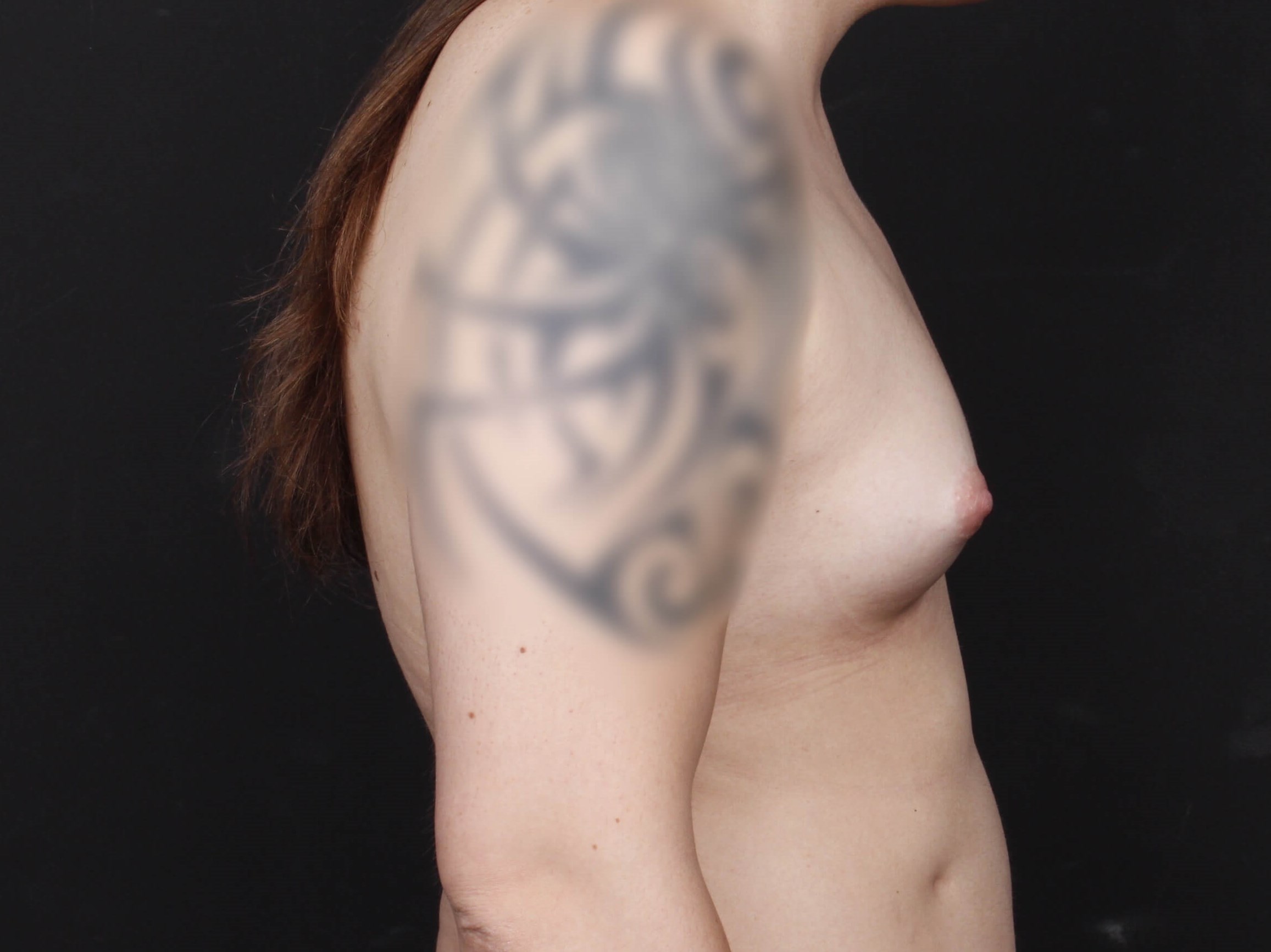 MTF Top Surgery Before