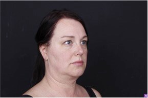Neck and Chin Liposuction Before
