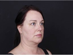 Neck and Chin Liposuction Before