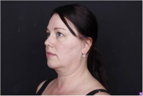 Neck and Chin Liposuction Before