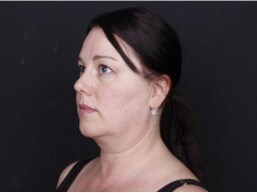 Neck and Chin Liposuction Before