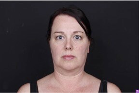 Neck and Chin Liposuction Before