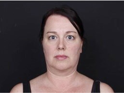 Neck and Chin Liposuction Before