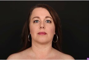 Neck and Chin Liposuction After