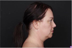 Neck and Chin Liposuction Before