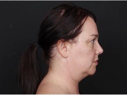 Neck and Chin Liposuction Before