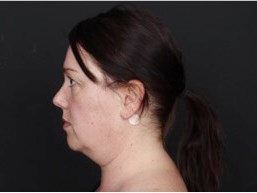 Neck and Chin Liposuction Before