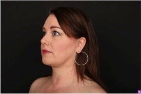 Neck and Chin Liposuction After