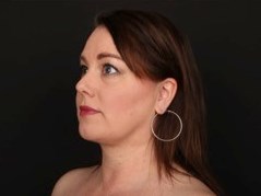 Neck and Chin Liposuction After