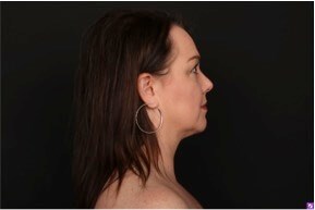 Neck and Chin Liposuction After