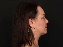 Neck and Chin Liposuction After
