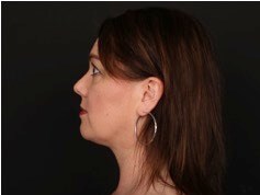 Neck and Chin Liposuction After