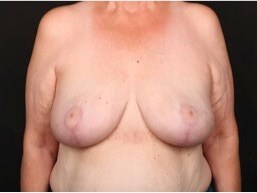 Bilateral Breast Lift After